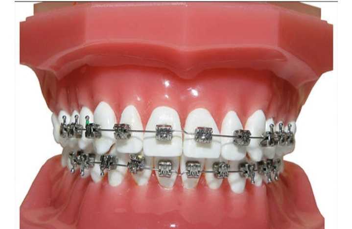 teeth braces