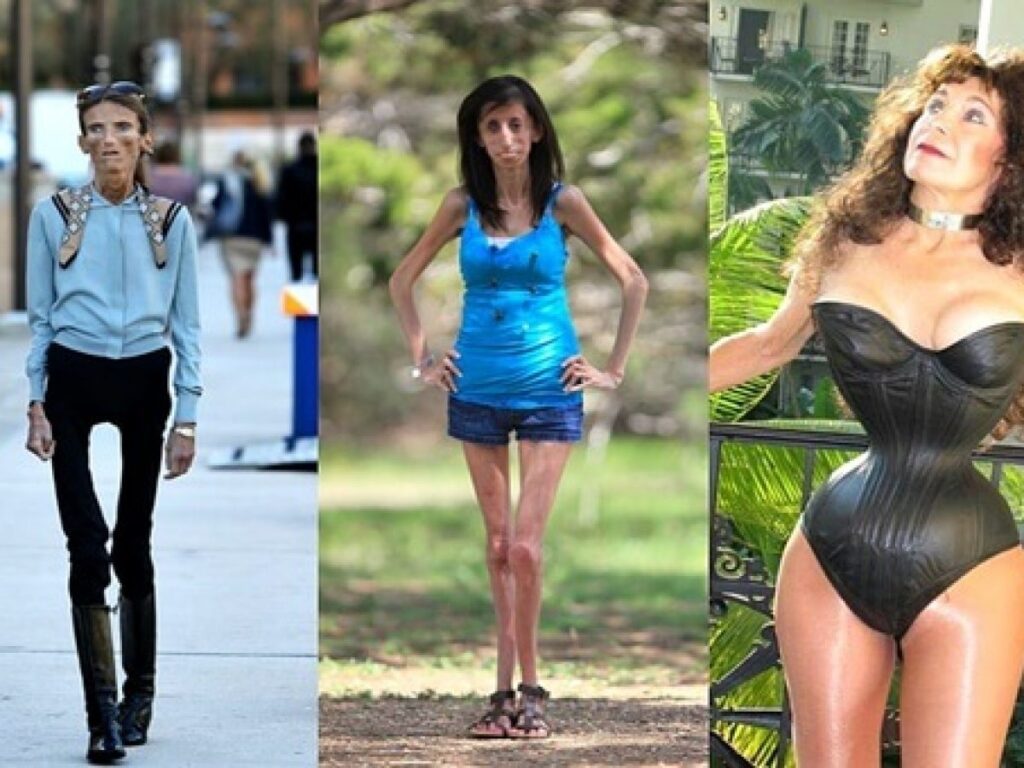 Skinniest persons in the world